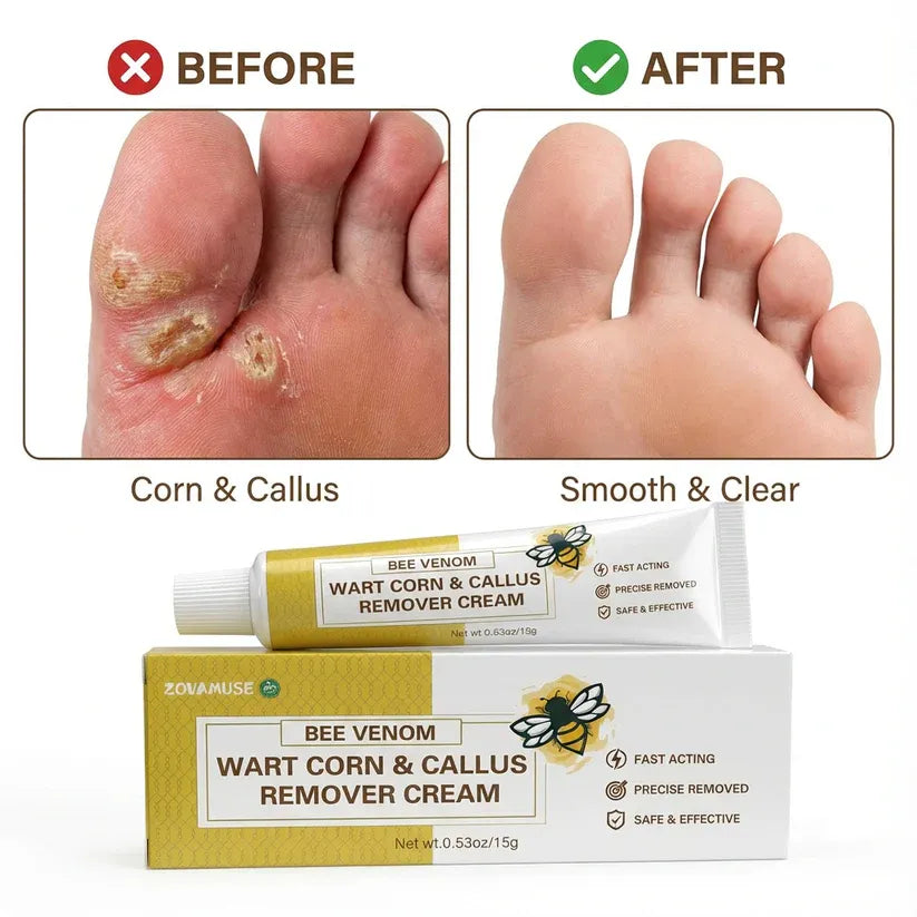 Bee Venom Corn & Callus Remover Cream